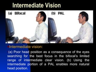 Intermediate Vision Intermediate vision: (a) Poor head position as a consequence of the eyes searching for the best focus in the bifocal’s limited range of intermediate clear vision. (b) Using the intermediate portion of a PAL enables more natural head position.  (a)  Bifocal (b)  PAL 