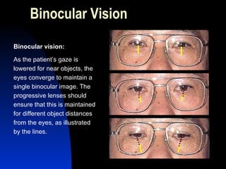 Binocular Vision Binocular vision: As the patient’s gaze is lowered for near objects, the eyes converge to maintain a single binocular image. The progressive lenses should ensure that this is maintained for different object distances from the eyes, as illustrated by the lines. 