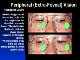 Peripheral (Extra-Foveal) Vision Peripheral vision: The PAL design should ensure that *objects in the periphery of the visual field are easily fused. **The distribution of prism in each lens should also be balanced for binocular viewing. ***Corresponding areas in the two lenses should provide a similar level of vision. 