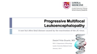 Progressive Multifocal
Leukoencephalopathy
A rare but often fatal disease caused by the reactivation of the JC virus.

Daniel Vela-Duarte, MD
PGY-3. Department of Neurology

Loyola University Medical Center
January, 2014

 