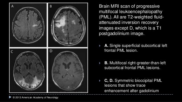 Progressive multifocal leukoencephalopathyProgressive multifocal leukoencephalopathy