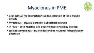 Myoclonus in PME
• Brief (20-50) ms contraction/ sudden cessation of tonic muscle
activity
• Myoclonus – Usually Cortical > Subcortical in origin
• In PME – Both negative and positive myoclonus may be seen
• Epileptic myoclonus – Due to descending neuronal firing of action
potentials
 
