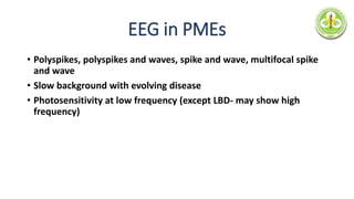 EEG in PMEs
• Polyspikes, polyspikes and waves, spike and wave, multifocal spike
and wave
• Slow background with evolving disease
• Photosensitivity at low frequency (except LBD- may show high
frequency)
 