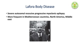 Lafora Body Disease
• Severe autosomal recessive progressive myoclonic epilepsy
• More frequent in Mediterranean countries, North America, Middle
east
 