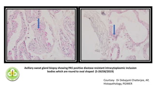 Axillary sweat gland biopsy showing PAS positive diastase resistant intracytoplasmic inclusion
bodies which are round to oval shaped (S-26258/2019)
Courtsey- Dr Debajyoti Chatterjee, AP,
Histopathology, PGIMER
 