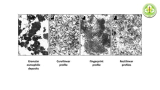 Granular
osmophilic
deposits
Curvilinear
profile
Fingerprint
profile
Rectilinear
profiles
 