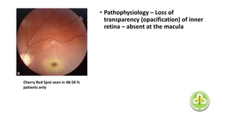 • Pathophysiology – Loss of
transparency (opacification) of inner
retina – absent at the macula
Cherry Red Spot seen in 48-50 %
patients only
 