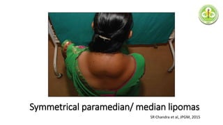 Symmetrical paramedian/ median lipomas
SR Chandra et al, JPGM, 2015
 