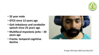 • 32 year male
• GTCS since 12 years age
• Gait imbalance and cerebellar
speech since 25 years age
• Multifocal myoclonic jerks – 30
years age
• Fronto- temporal cognitive
decline
R Singh, MK Goyal, BMJ Case Rep 2017
 