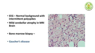 • EEG – Normal background with
intermittent polyspikes
• Mild cerebellar atrophy in MRI
Brain
• Bone marrow biopsy –
• Gaucher’s disease
 