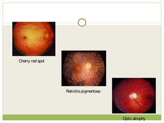 Cherry red spot
Retinitispigmentosa
Optic atrophy
 