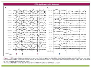 Myoclonic Seizure Eeg