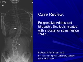 Case Review:
            Progressive Adolescent
            Idiopathic Scoliosis, treated
48°
            with a posterior spinal fusion
            T3-L1.


      25°


            Robert S Pashman, MD
            Scoliosis and Spinal Deformity Surgery
            www.eSpine.com
 