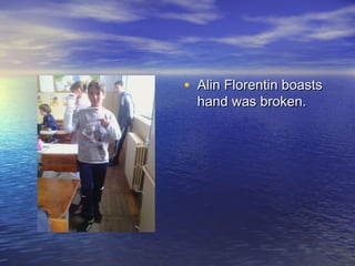 • Alin Florentin boasts
hand was broken.

 