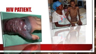 HIV PATIENT.
 