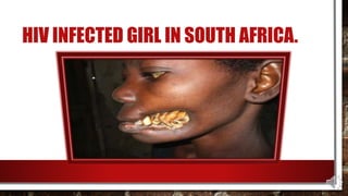 HIV INFECTED GIRL IN SOUTH AFRICA.
 