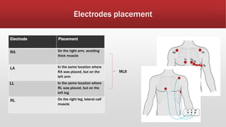 Electrodes placement
Electrode Placement
RA On the right arm, avoiding
thick muscle
LA In the same location where
RA was placed, but on the
left arm
LL In the same location where
RL was placed, but on the
left leg
RL On the right leg, lateral calf
muscle
MLII
 