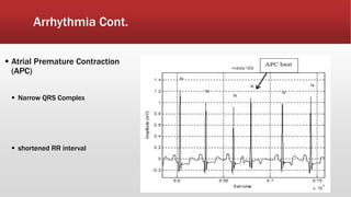 Arrhythmia Cont.
 Atrial Premature Contraction
(APC)
 Narrow QRS Complex
 shortened RR interval
 