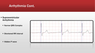 Arrhythmia Cont.
 Supraventricular
Arrhythmia
 Narrow QRS Complex
 Shortened RR interval
 Hidden P wave
 