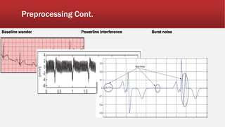 Preprocessing Cont.
Baseline wander Powerline interference Burst noise
 