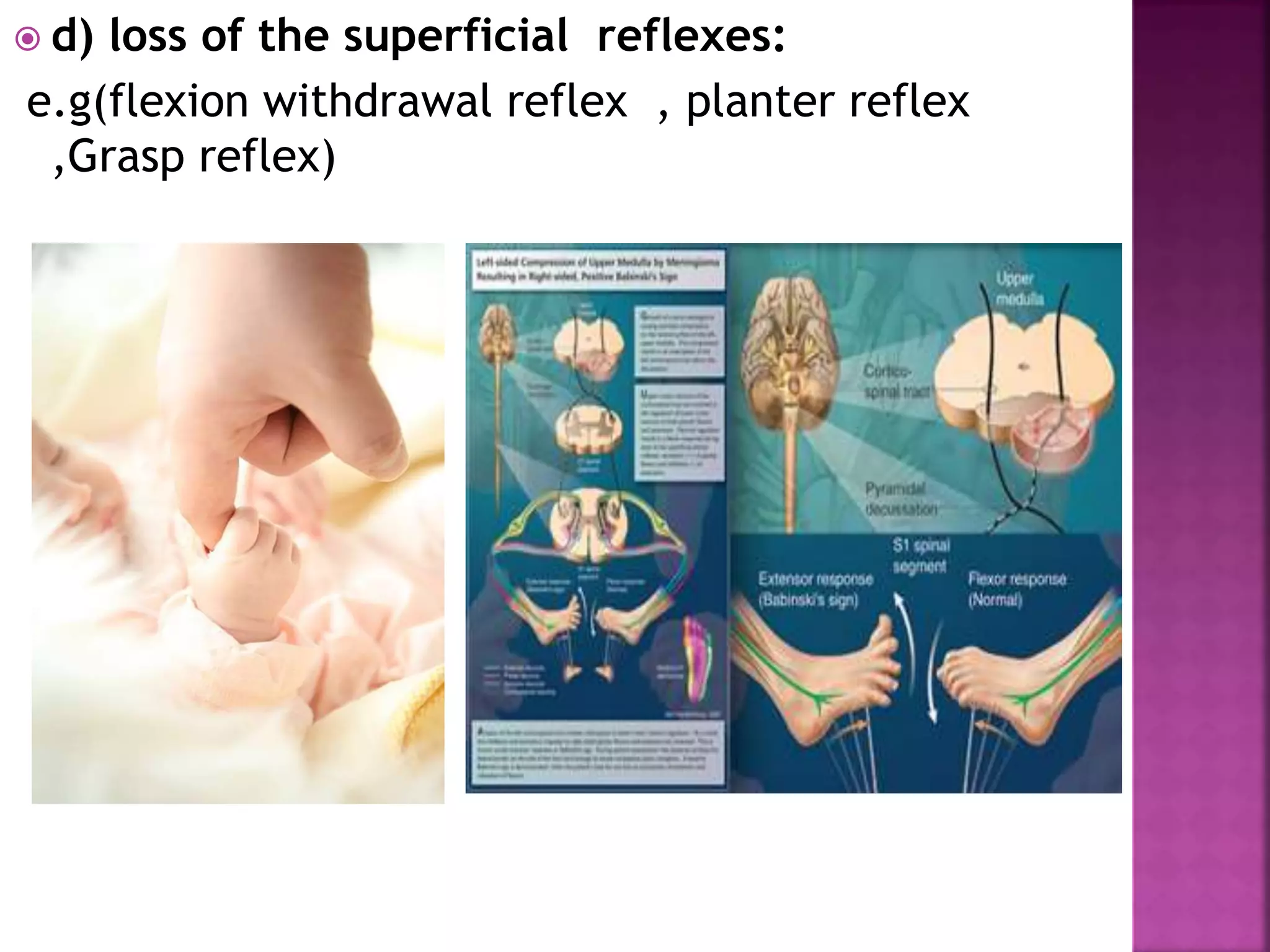  d) loss of the superficial reflexes:
e.g(flexion withdrawal reflex , planter reflex
,Grasp reflex)
 