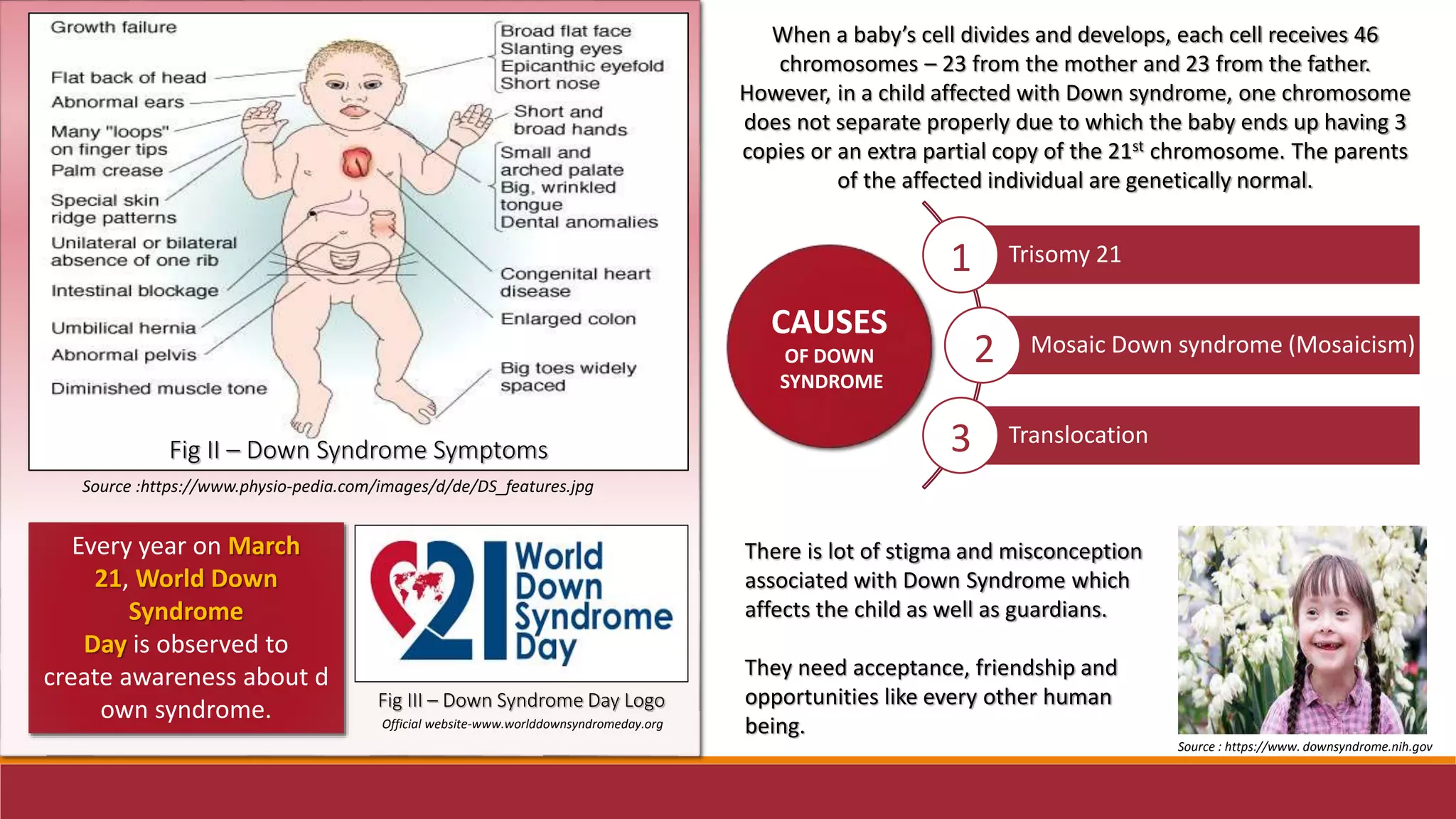 Source :https://www.physio-pedia.com/images/d/de/DS_features.jpg
Fig II – Down Syndrome Symptoms
Every year on March
21, World Down
Syndrome
Day is observed to
create awareness about d
own syndrome. Official website-www.worlddownsyndromeday.org
Fig III – Down Syndrome Day Logo
Trisomy 21
Mosaic Down syndrome (Mosaicism)
Translocation
CAUSES
OF DOWN
SYNDROME
1
2
3
When a baby’s cell divides and develops, each cell receives 46
chromosomes – 23 from the mother and 23 from the father.
However, in a child affected with Down syndrome, one chromosome
does not separate properly due to which the baby ends up having 3
copies or an extra partial copy of the 21st chromosome. The parents
of the affected individual are genetically normal.
There is lot of stigma and misconception
associated with Down Syndrome which
affects the child as well as guardians.
They need acceptance, friendship and
opportunities like every other human
being.
Source : https://www. downsyndrome.nih.gov
 