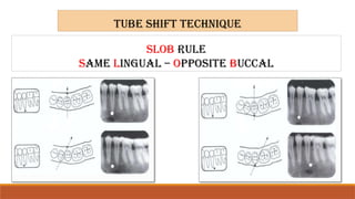 Using Slob Rule Radiograph Comprehensive Guide to Dental Projection Geometry and Radiographic ...