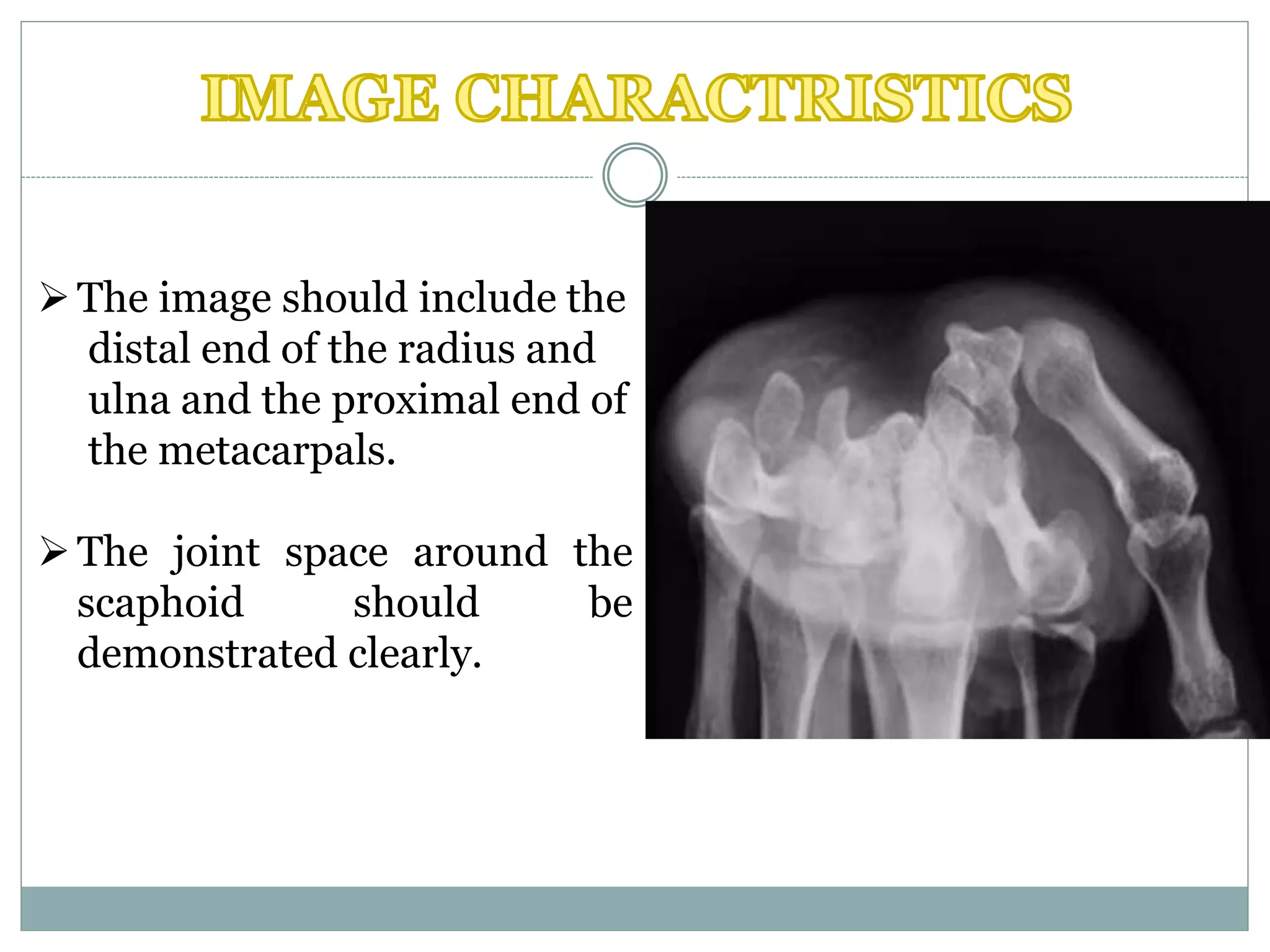 The image should include the
distal end of the radius and
ulna and the proximal end of
the metacarpals.
The joint space around the
scaphoid should be
demonstrated clearly.
 