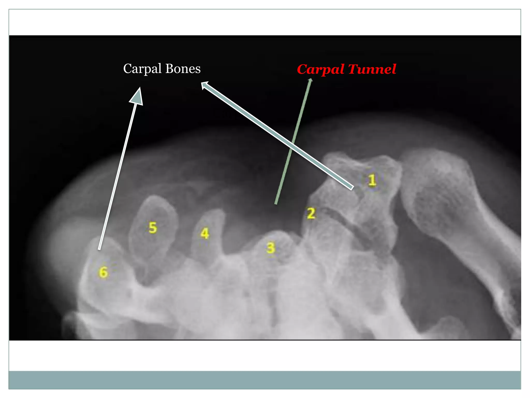 Carpal
Carpal TunnelCarpal Bones
 