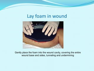 Lay foam in wound
Gently place the foam into the wound cavity, covering the entire
wound base and sides, tunneling and undermining
 
