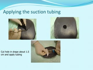 Applying the suction tubing
Cut hole in drape about 1.5
cm and apply tubing
 
