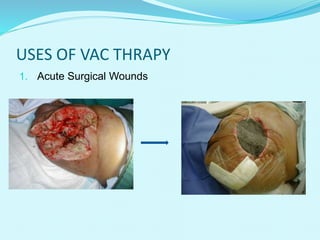 USES OF VAC THRAPY
1. Acute Surgical Wounds
 
