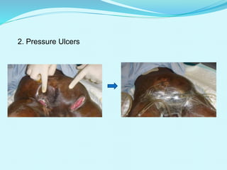 2. Pressure Ulcers
 