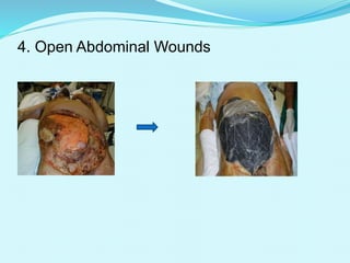 4. Open Abdominal Wounds
 