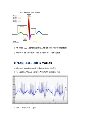 □ An Ideal ECG Looks LikeThis And ItKeeps Repeating Itself.
□ We Will Try To Detect The R-Peaks In This Project.
R-PEAKS DETECTION IN MATLAB
□ A General Noise Corrupted ECG signal Looks Like This
□ The ECG Sinal We Are Going To Work With Looks Like This
□ A Closer Look At The Signal
 