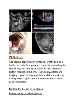 PURPOSE
A sonogram captures a live image of what's going on
inside the body. Sonography is useful for evaluating the
size, shape, and density of tissues to help diagnose
certain medical conditions. Traditionally, ultrasound
imaging is great for looking into the abdomen without
having to cut it open. Abdominal ultrasound is often
used to diagnose:
Gallbladder disease or gallstones
Kidney stones or kidney disease
 