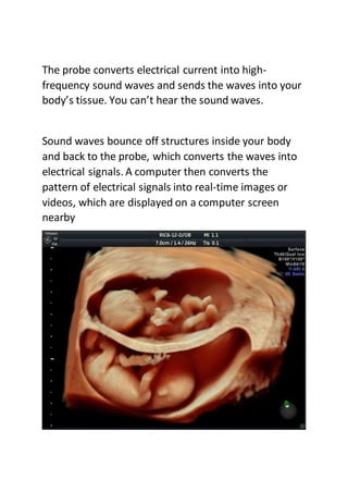 The probe converts electrical current into high-
frequency sound waves and sends the waves into your
body’s tissue. You can’t hear the sound waves.
Sound waves bounce off structures inside your body
and back to the probe, which converts the waves into
electrical signals. A computer then converts the
pattern of electrical signals into real-time images or
videos, which are displayed on a computer screen
nearby
 