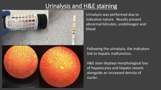Urinalysis and H&E staining
Urinalysis was performed due to
indicative nature. Results present
abnormal bilirubin, urobilinogen and
blood
Following the urinalysis, the indicators
link to hepatic malfunction.
H&E stain displays morphological loss
of hepatocytes and hepatic vessels
alongside an increased density of
nuclei.
 