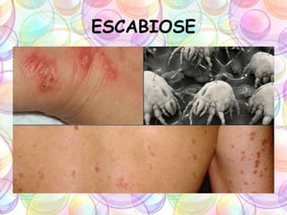 ESCABIOSE
 