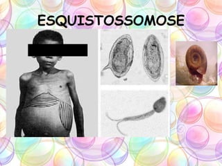 ESQUISTOSSOMOSE
 