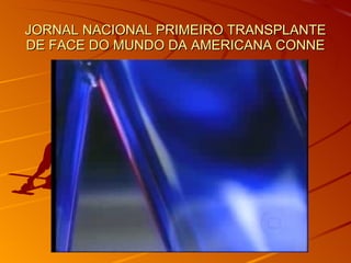 JORNAL NACIONAL PRIMEIRO TRANSPLANTE DE FACE DO MUNDO DA AMERICANA CONNE 