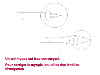 Un œil myope est trop convergent.  Pour corriger la myopie, on utilise des lentilles divergentes  