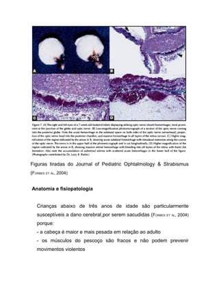 Figuras tiradas do Journal of Pediatric Ophtalmology & Strabismus
(FORBES ET AL, 2004)


Anatomia e fisiopatologia


   Crianças abaixo de três anos de idade são particularmente
   susceptíveis a dano cerebral por serem sacudidas (FORBES ET AL, 2004)
   porque:
   - a cabeça é maior e mais pesada em relação ao adulto
   - os músculos do pescoço são fracos e não podem prevenir
   movimentos violentos
 