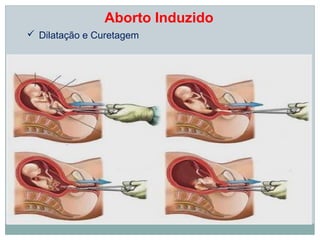 Aborto Induzido
 Dilatação e Curetagem
 