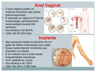 Anel Vaginal
• O anel vaginal contêm os
  mesmos hormônios das pílulas
  anticoncepcionais.
• É colocado na vagina no 5°dia da
  menstruação, permanecendo
  nesta posição durante três
  semanas.
• Sua eficácia é de 99,9%.
• Valor: De 30 a 60 reais.

                               Implante
• São pequenas hastes do tamanho de um
  palito de fósforo implantados sob a pele.
• Essas hastes liberam hormônios que
  impedem a ovulação.
• É um método caro e pode causar
  irregularidades menstruais.
• Tem validade de 3 anos.
• Sua eficácia é de 100%.
• Valor: De 300 a 1.000 reais
 