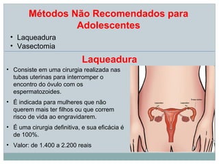 Métodos Não Recomendados para
                 Adolescentes
 • Laqueadura
 • Vasectomia
                            Laqueadura
• Consiste em uma cirurgia realizada nas
  tubas uterinas para interromper o
  encontro do óvulo com os
  espermatozoides.
• É indicada para mulheres que não
  querem mais ter filhos ou que correm
  risco de vida ao engravidarem.
• É uma cirurgia definitiva, e sua eficácia é
  de 100%.
• Valor: de 1.400 a 2.200 reais
 