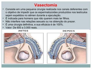 Vasectomia
• Consiste em uma pequena cirurgia realizada nos canais deferentes com
  o objetivo de impedir que os espermatozoides produzidos nos testículos
  sejam expelidos no sêmen durante a ejaculação.
• É indicada para homens que não querem mais ter filhos.
• Não interfere nas relações sexuais ou na obtenção do prazer.
• É uma cirurgia definitiva, e sua eficácia é de 100%.
• Valor: De 600 a 3.000 reais.
 