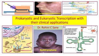 Prokaryotic and Eukaryotic Transcription with
their clinical applications
Dr. Rohini C Sane
Burkittlymphoma
Systemic lupus erythematosus
 