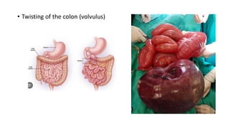 • Twisting of the colon (volvulus)
 
