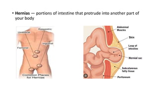 • Hernias — portions of intestine that protrude into another part of
your body
 